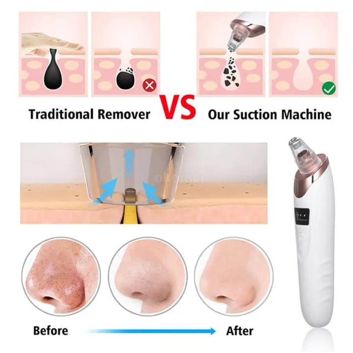 Face Vacuum Suction Blackhead Remover | Electric Pore Cleaner & Deep Cleansing Tool